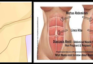 Abdominal Separation