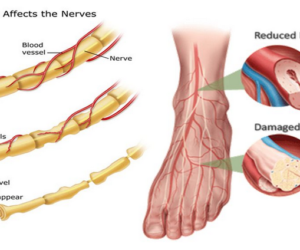 Peripheral Neuropathy, Proximal Neuropothy, Autonomic Neuropathy