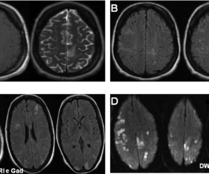 Central Nervous System Vasculitis