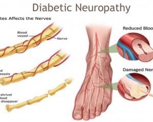 Peripheral Neuropathy