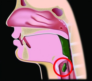 Dysphagia