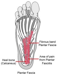 Plantar-Fasciosis, Plantar-Fasciopathy, Jogger's-Heel, Heel-Spur-Syndrome