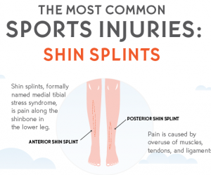 Medial Tibal Stress Syndrome