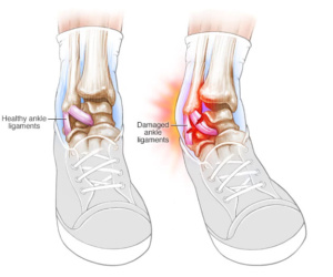 Twisted Ankle, Rolled Ankle