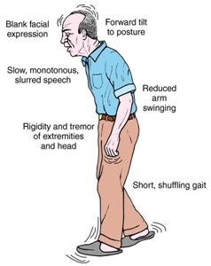 Parkinson’s Disease, Idiopathic Parkinsonism, Paralysis agitans